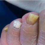 Foot Dermatology, Nail infection, nail infection treatment, Laser Nail Fungus Treatments, laser nail, laser fungus westminster,nail infection, nail disease, nail, toenail, Laser toenail, laser fingernail, fingernail infection, laser nail fungus westminster