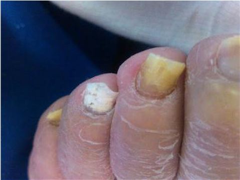 Foot Dermatology, Nail infection, nail infection treatment, Laser Nail Fungus Treatments, laser nail, laser fungus westminster,nail infection, nail disease, nail, toenail, Laser toenail, laser fingernail, fingernail infection, laser nail fungus westminster