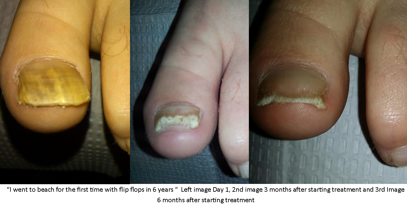 Laser Toenail Fungus Treatment | Podiatrist NYC Downtown | Step Up Footcare