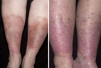 Venous Insufficiency, Venous Stasis