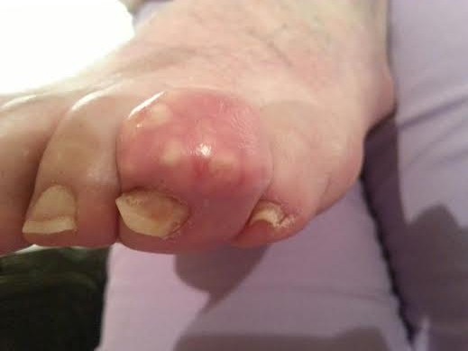 Painful big toe joint, hallux limitus, hallux rigidus, bunion, gout, big toe implant, big toe fusion, arthritis, big toe arthritis, sesmoiditis, 