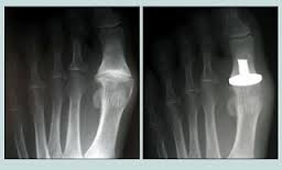 Hallux Limitus Treatment, Painful big toe joint, Big Toe Pain Treatment, hallux limitus, hallux rigidus, bunion, gout, big toe implant, big toe fusion, arthritis, big toe arthritis, sesmoiditis, 