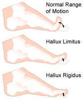 Painful big toe joint, hallux limitus, hallux rigidus, bunion, gout, big toe implant, big toe fusion, arthritis, big toe arthritis, sesmoiditis, 