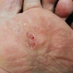 Plantar Wart, mosaic wart, foot wart