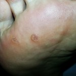 Plantar Wart, mosaic wart, foot wart