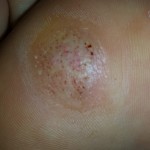 Plantar Wart