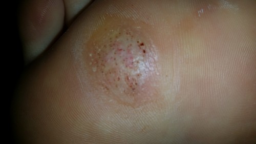 Plantar Warts