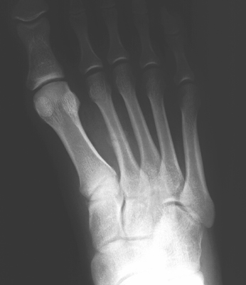 Stress Fracture