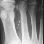 Stress Fracture