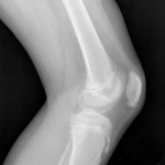 Sever's Disease, osgood Schlatter, Apophysitis