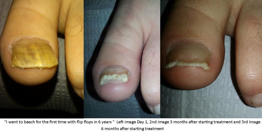 Laser Nail Fungus Removal Treatments