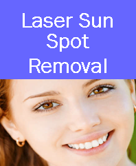 laser sun spot removal, sun spot removal, laser sun spot removal denver, laser sun spot removal westminster, laser sun spot removal colorado